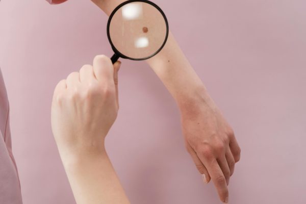 A melanoma tünetei és felismerése melanoma